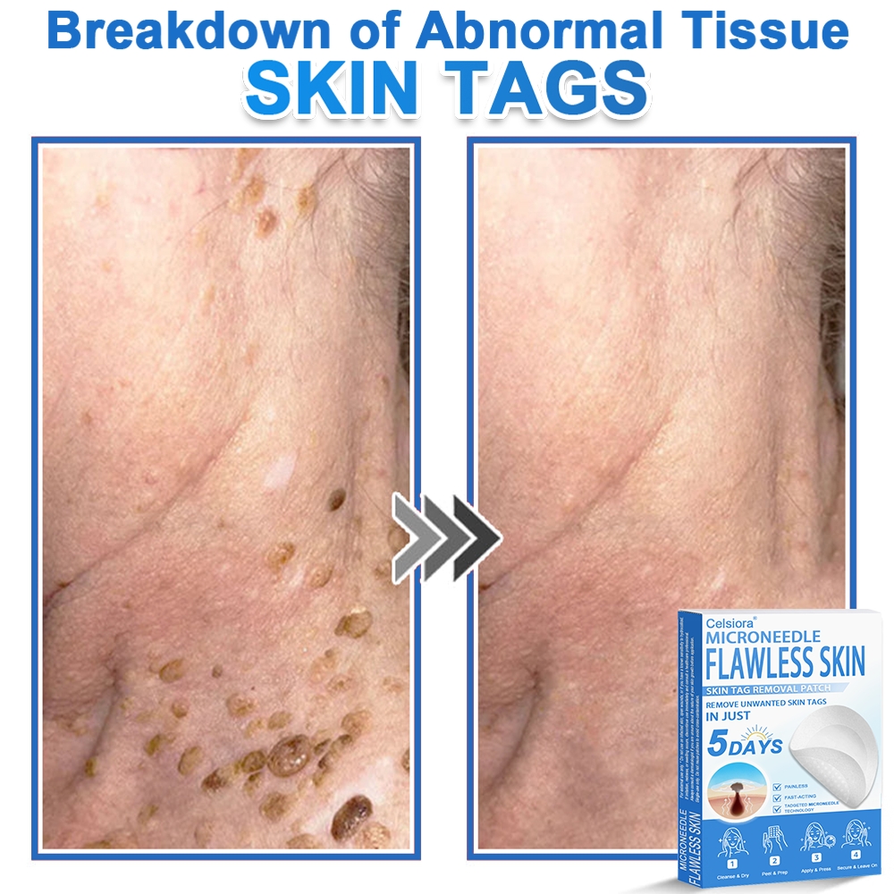 🎁2-in-1 Microneedle & Hydrocolloid Patch | Raised Moles,Acne, Flat Warts & Skin Tags Remover | Improves Wrinkles, Scars & Blemishes | Invisible Pimple Patches for Face & Body