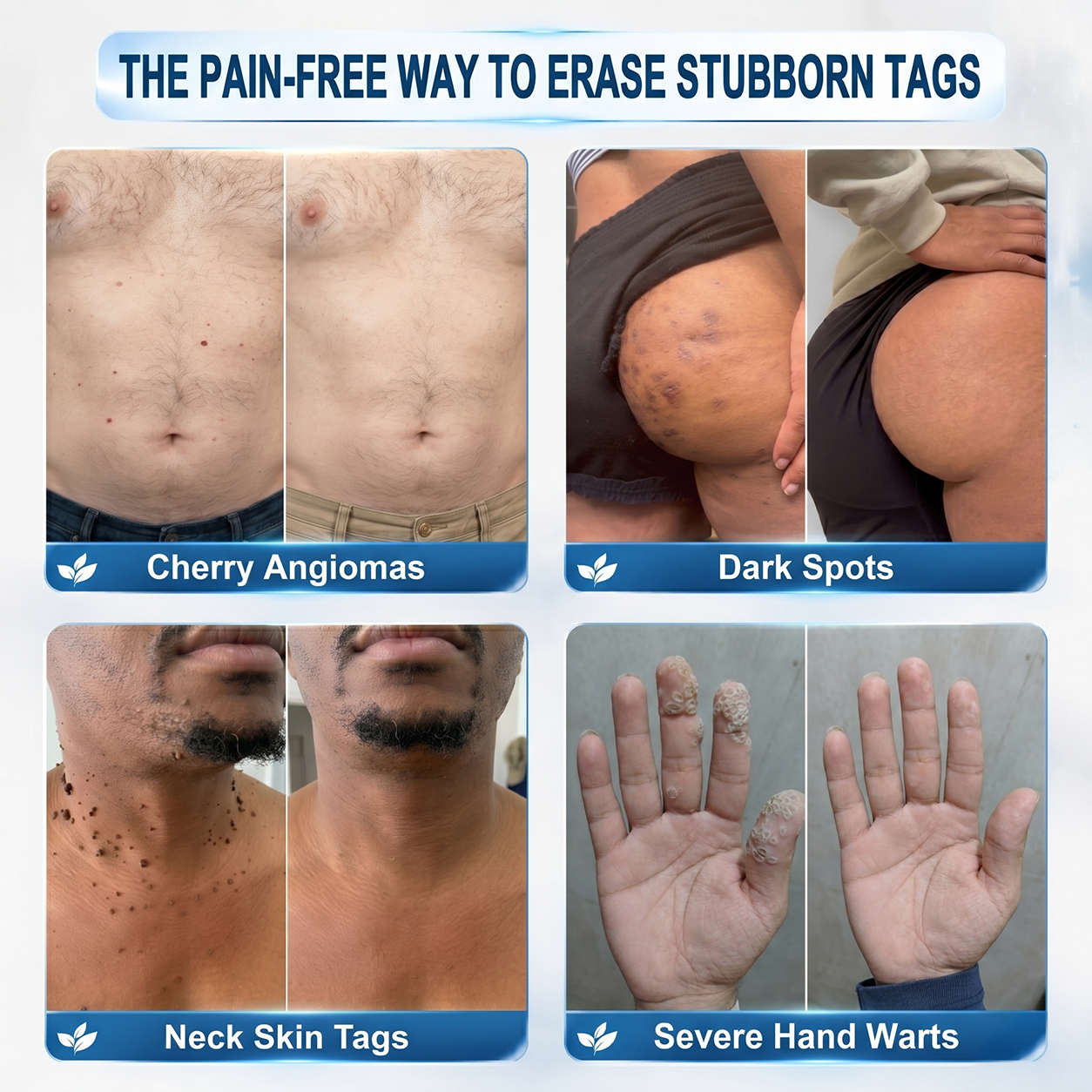 Effective MicroNeedle BotanicSkinTag Removal Patch