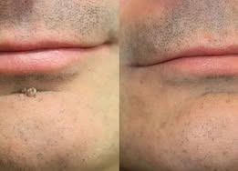 ✨2-in-1 Microneedle & Hydrocolloid Patch🍀| Removes Raised Moles, Acne, Flat Warts & Skin Tags | Helps Improve Wrinkles, Scars & Blemishes | Invisible Patches for Face & Body