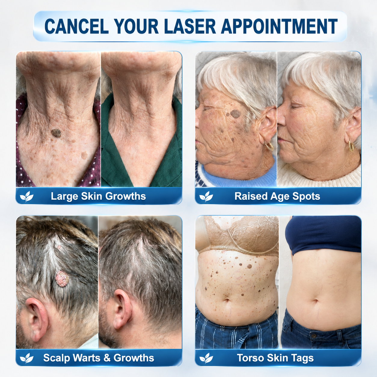 Effective MicroNeedle BotanicSkinTag Removal Patch