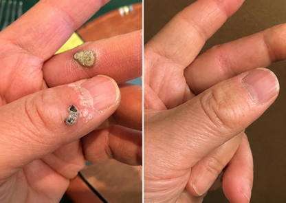 ✨2-in-1 Microneedle & Hydrocolloid Patch🍀| Removes Raised Moles, Acne, Flat Warts & Skin Tags | Helps Improve Wrinkles, Scars & Blemishes | Invisible Patches for Face & Body